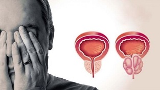 erkeklerde prostatit nedenleri