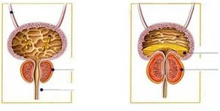 erkeklerde prostatit türleri ve formları