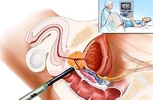prostatiti teşhis etme yolları