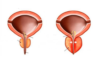 akut prostatit nedir