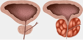 prostatit nedir