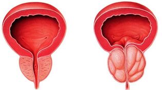 Prostatit