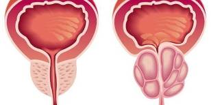 prostatit