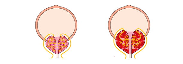 prostatit ile sağlıklı ve iltihaplı prostat