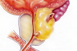 prostatit
