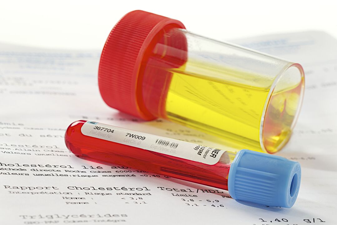 Bir kan ve idrar testi, prostatit varlığının belirlenmesine yardımcı olacaktır.