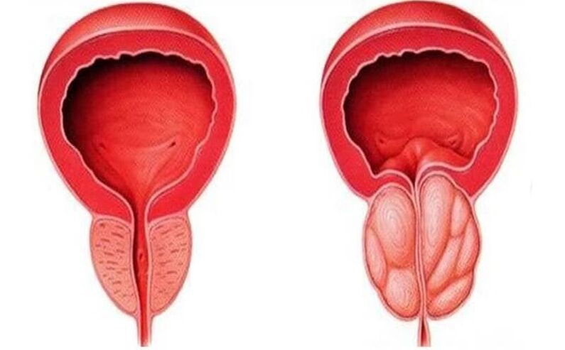 prostatit ile sağlıklı ve iltihaplı prostat