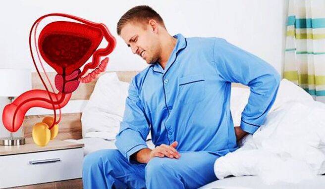 prostatit nedeniyle bel ağrısı
